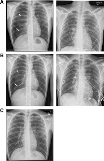 Pneumothorax — visible lung edge with absent peripheral lung markings (chest X-ray)