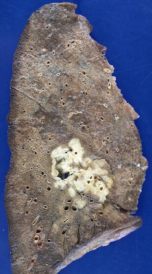 Cavitating pulmonary tuberculosis (tuberculoma) — gross pathology specimen